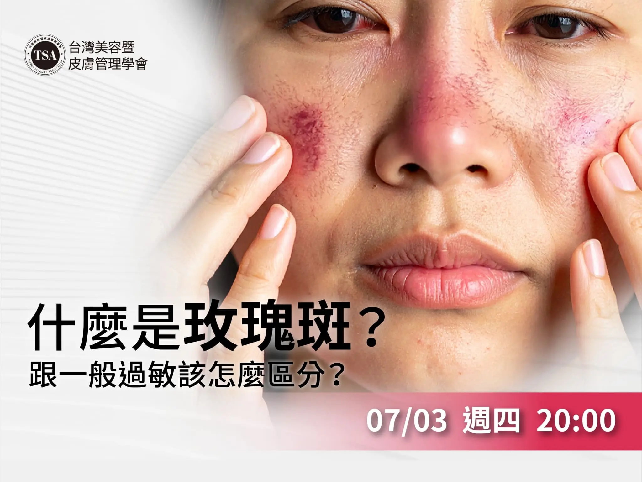 Tsa內訓課 什麼是玫瑰斑？跟一般過敏該怎麼區分？