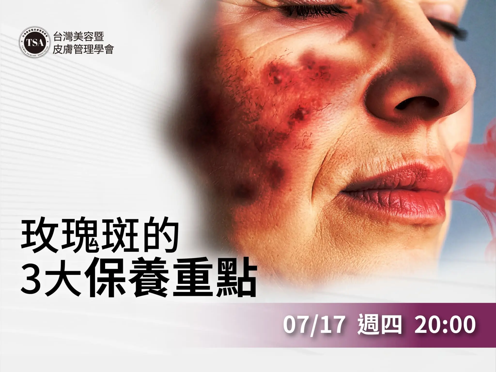 Tsa內訓課 玫瑰斑的三大保養重點